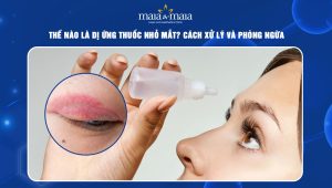 Dị ứng thuốc nhỏ mắt