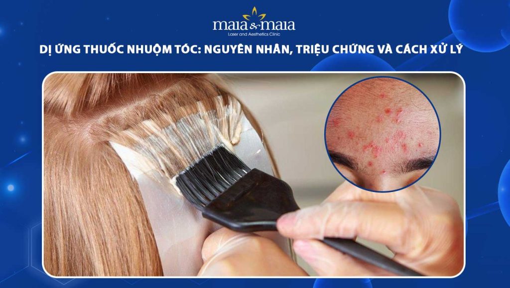 dị ứng thuốc nhuộm tóc