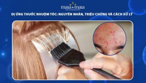 dị ứng thuốc nhuộm tóc