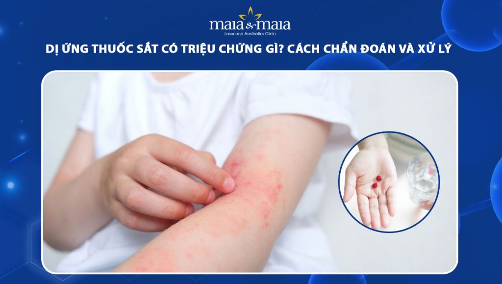 dị ứng thuốc sắt