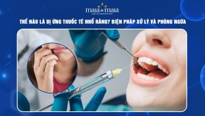 Dị ứng thuốc tê nhổ răng