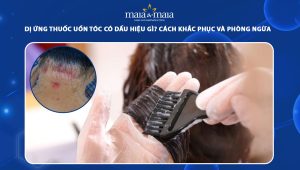 dị ứng thuốc uốn tóc