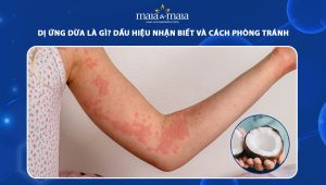 dị ứng với dừa
