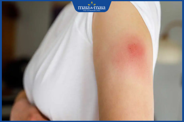 dị ứng vùng tiêm