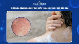 Dị ứng xà phòng