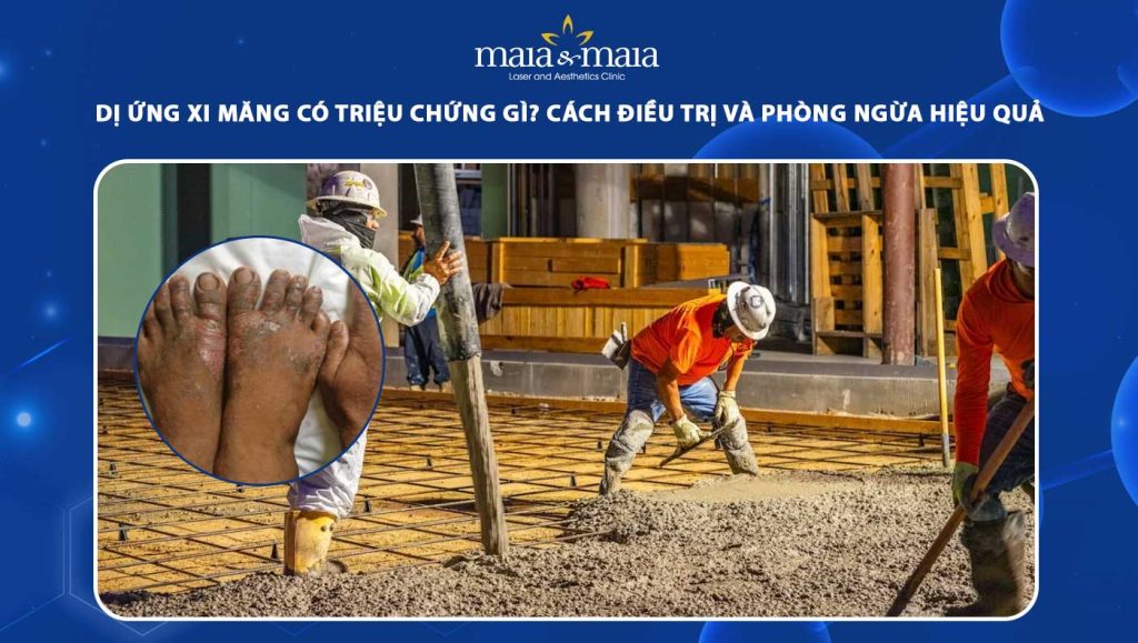 dị ứng xi măng