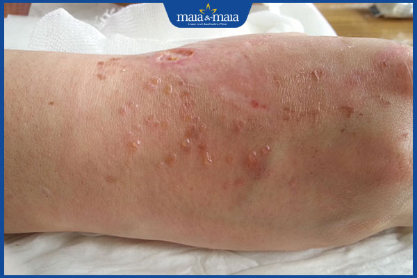 dị ứng xung quanh vết thương