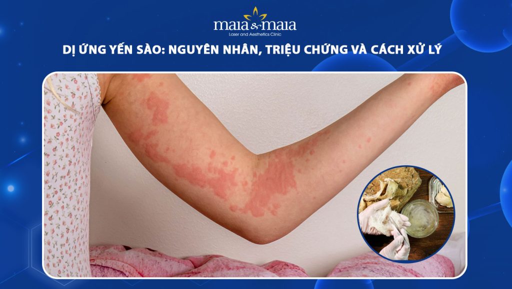 dị ứng yến sào