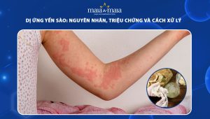 dị ứng yến sào