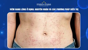 viêm nang lông ở bụng