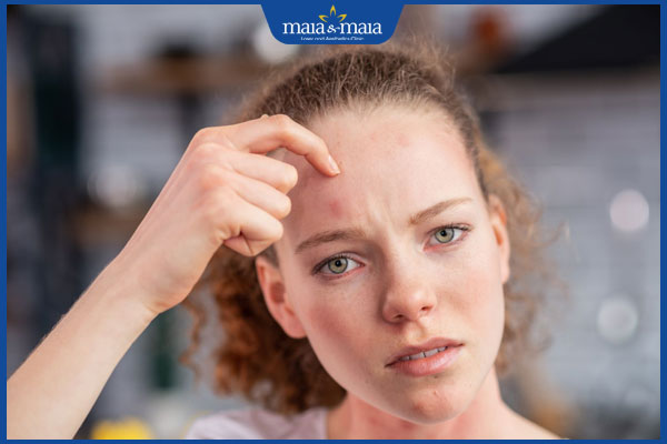 ngứa do thuốc nhuộm tóc