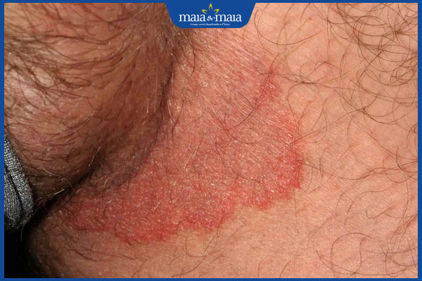 ngứa vùng kín nam