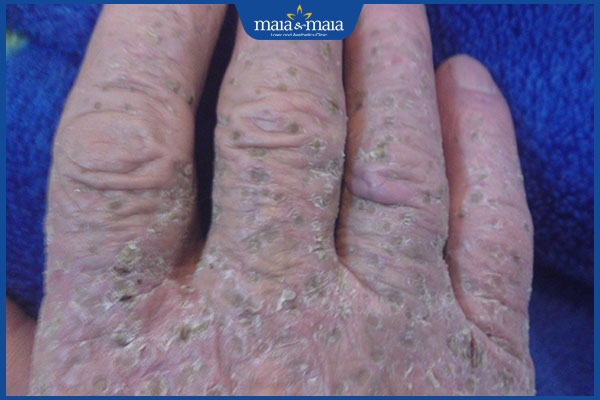 nhận biết dị ứng xi măng