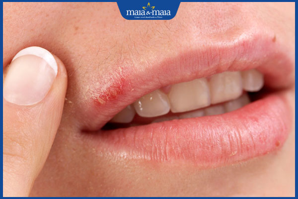 nhận biết viêm mép môi