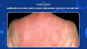 nhiễm độc da dị ứng thuốc