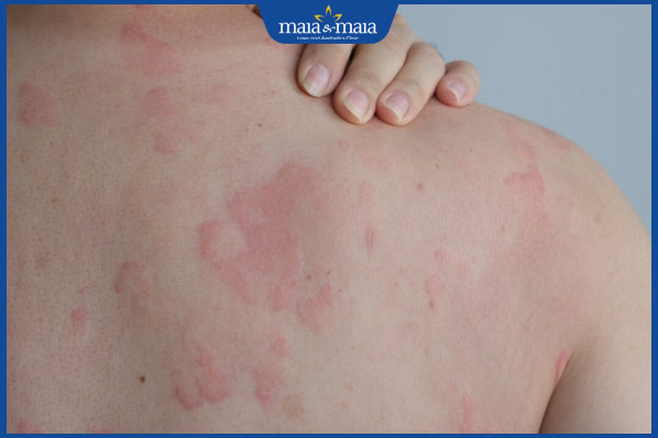 Dị ứng thời tiết lạnh: Nguyên nhân, dấu hiệu, cách điều trị 2 nổi mề đay toàn thân