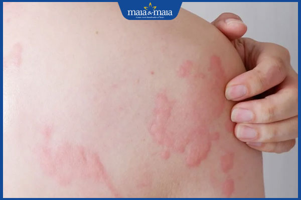 nổi mề đay trên da