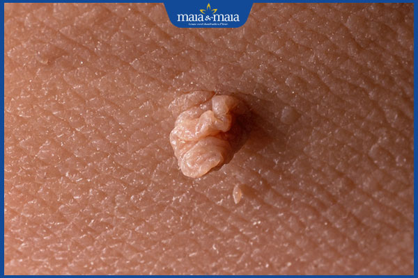 Mọc u mềm treo do đâu? Dấu hiệu và cách điều trị hiệu quả 3 nốt u mềm treo