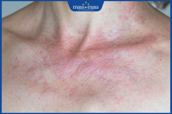 sẩn ngứa do ánh nắng