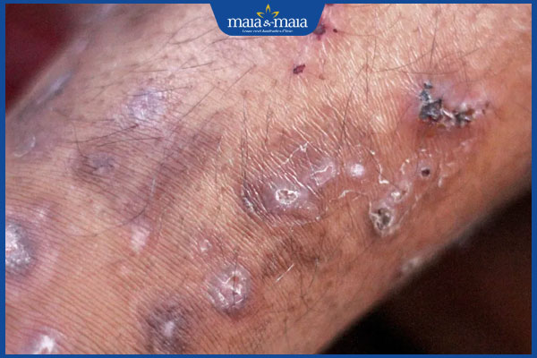 sẹo xấu do gãi nhiều