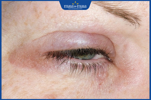 sưng mắt do dị ứng hải sản