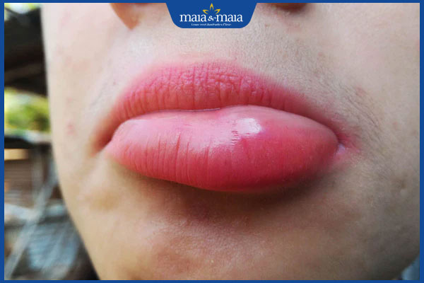 sưng môi