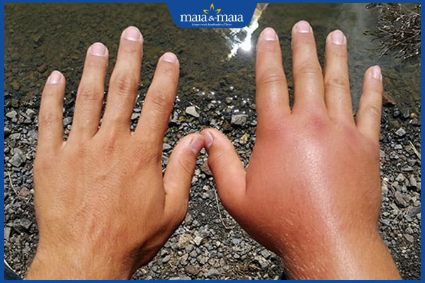 Dị ứng thời tiết lạnh: Nguyên nhân, dấu hiệu, cách điều trị 3 tay sưng nề