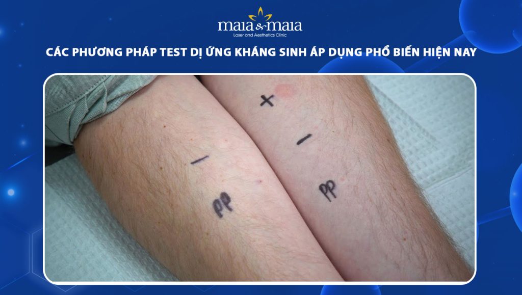 test dị ứng kháng sinh