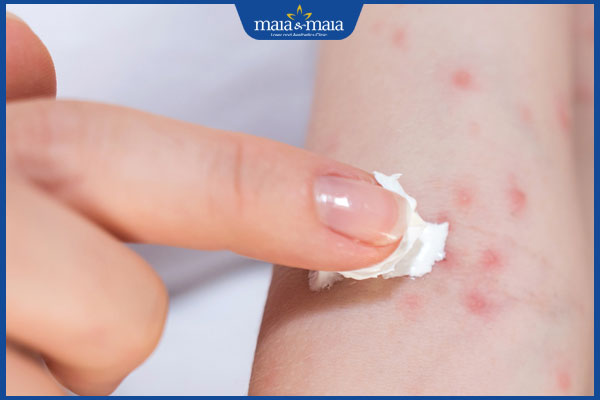 thoa kem giảm ngứa cho trẻ