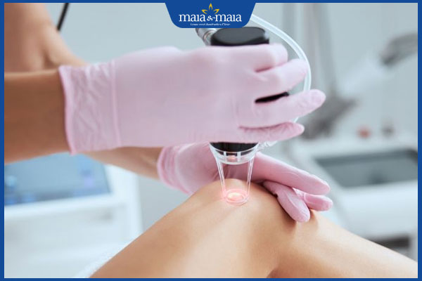 Ưu điểm khi trị sẩn cục bằng Laser CO2 và chi phí thực hiện 3 thực hiện trị sẩn cục bằng laser co2