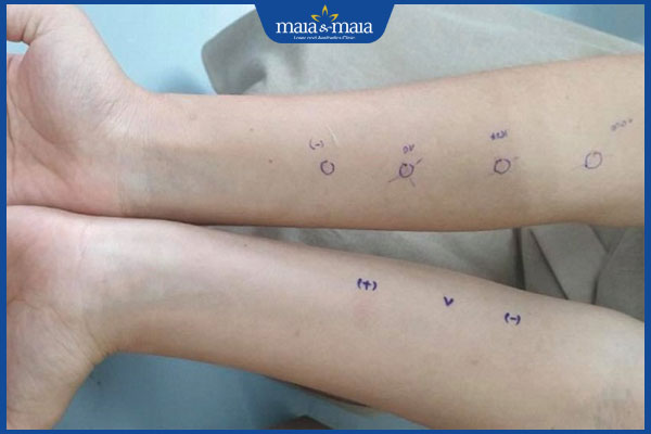 thực hiện xét nghiệm dị ứng