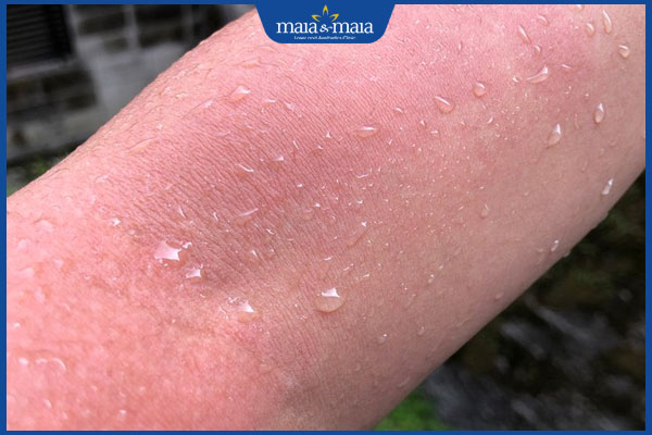 tiếp xúc với nước bị dị ứng