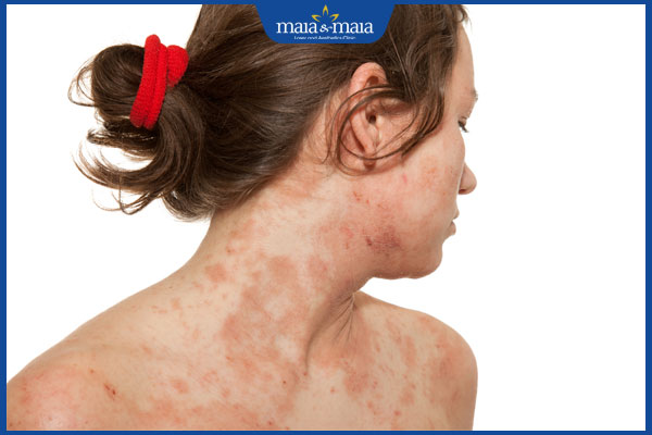 tình trạng dị ứng da ngứa toàn thân