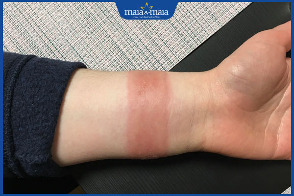 tình trạng dị ứng dây da đồng hồ