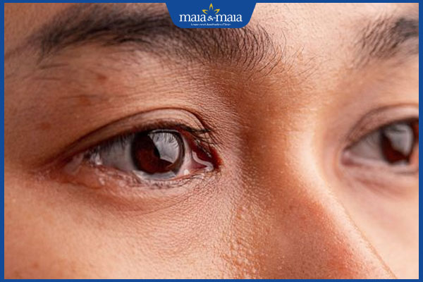 tình trạng dị ứng nước mắt