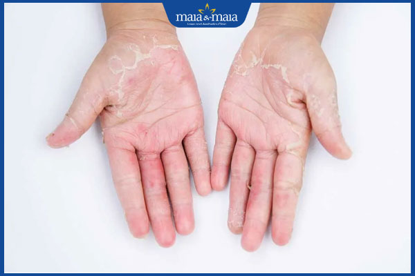 tình trạng dị ứng nước rửa chén