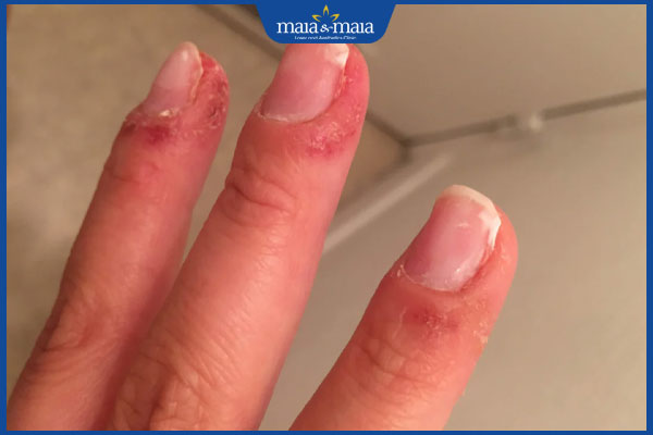 tình trạng dị ứng với sơn gel