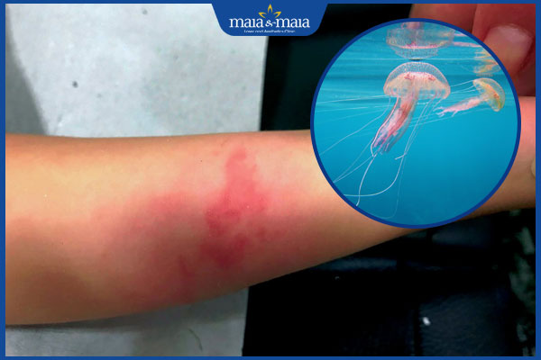 tình trạng dị ứng với sứa biển
