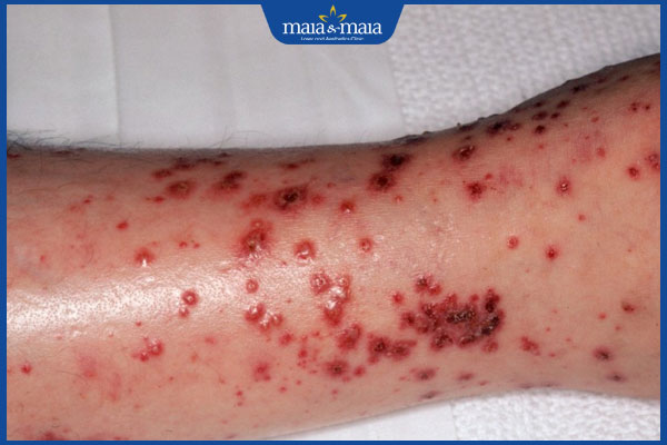 tình trạng nhiễm độc da dị ứng thuốc