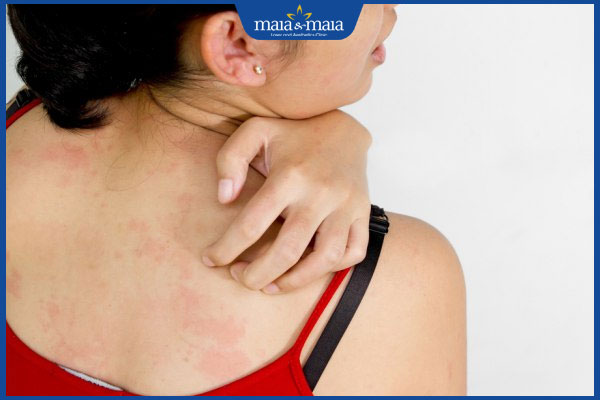 tình trạng sẩn ngứa do gan