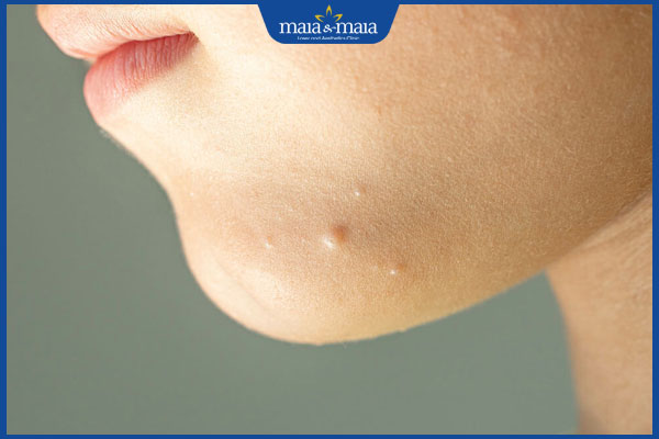 tình trạng u mềm lây