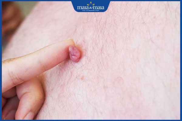 Mọc u mềm treo do đâu? Dấu hiệu và cách điều trị hiệu quả 2 tình trạng u mềm treo