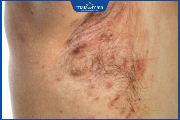 tình trạng viêm nang lông nách