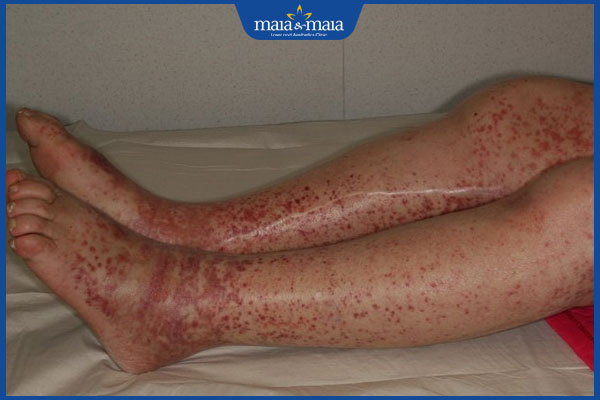 tình trạng viêm thành mạch dị ứng