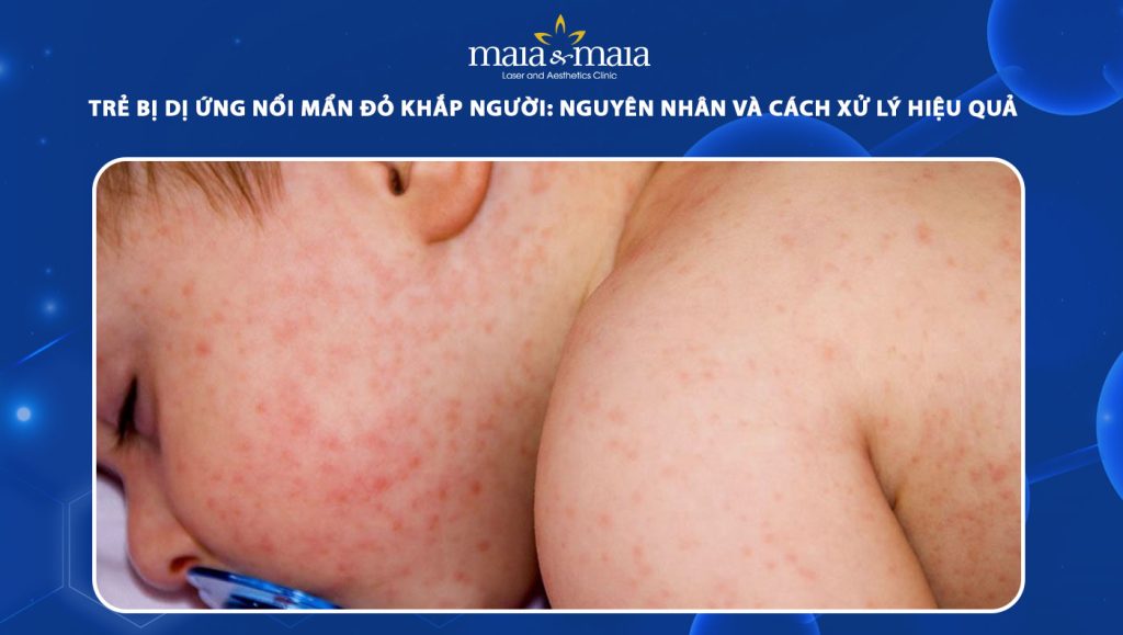 trẻ bị dị ứng nổi mẩn đỏ khắp người