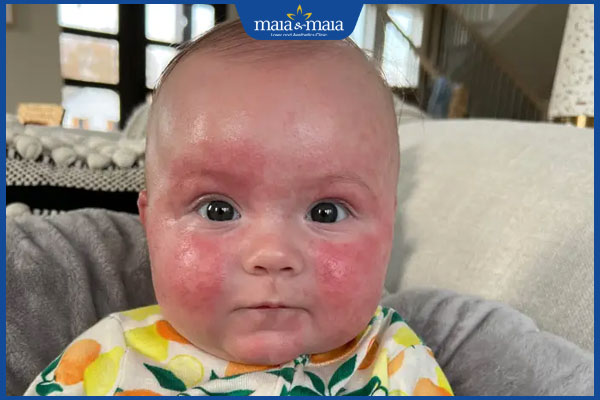 trẻ bị dị ứng nổi mẩn đỏ