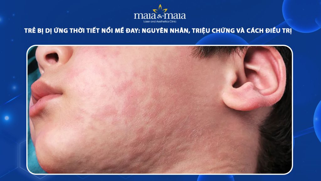 trẻ bị dị ứng thời tiết nổi mề đay