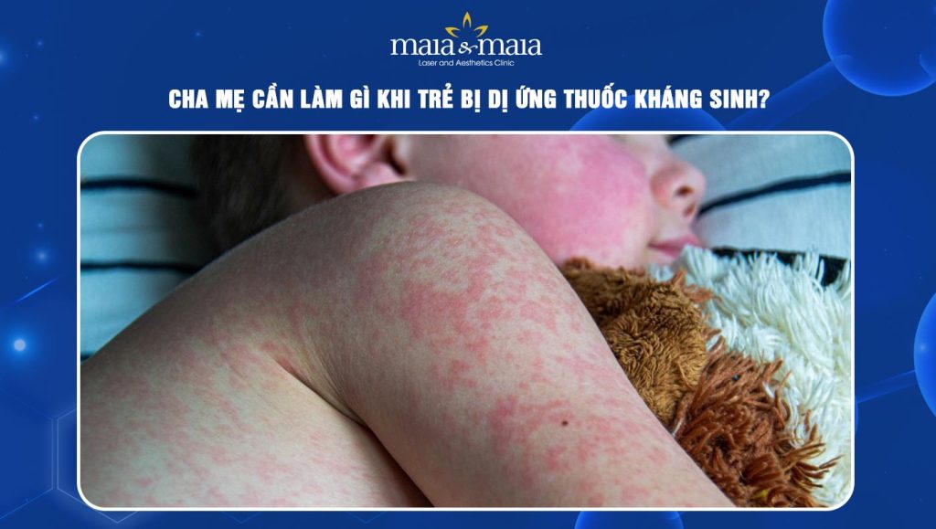 Trẻ bị dị ứng thuốc kháng sinh