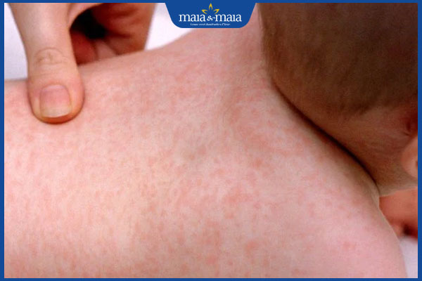 trẻ bị dị ứng