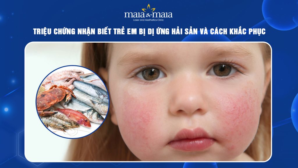 trẻ em bị dị ứng hải sản